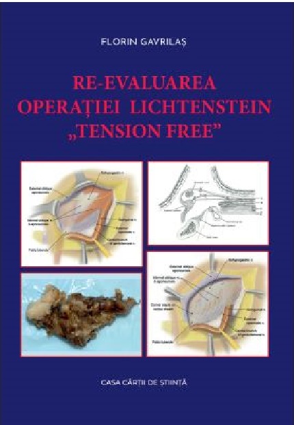 Re-evaluarea operatiei Lichtenstein „tension free”