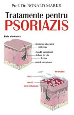 Tratamente Pentru Psoriazis